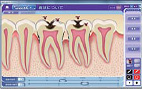 むし歯、歯周病の進行度合いの図