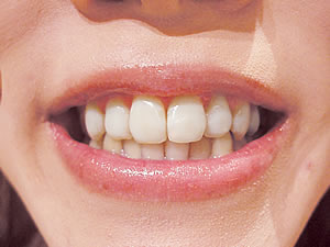 white_teeth
